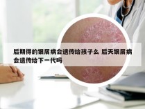 后期得的银屑病会遗传给孩子么 后天银屑病会遗传给下一代吗