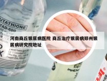 河南商丘银屑病医院 商丘治疗银屑病郑州银屑病研究院地址