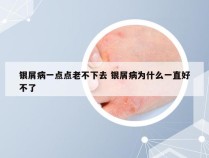 银屑病一点点老不下去 银屑病为什么一直好不了