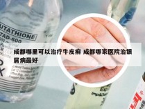 成都哪里可以治疗牛皮癣 成都哪家医院治银屑病最好