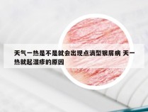 天气一热是不是就会出现点滴型银屑病 天一热就起湿疹的原因