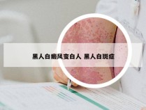 黑人白癜风变白人 黑人白斑症