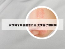 女性得了银屑病怎么治 女生得了银屑病