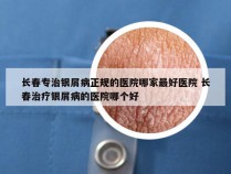 长春专治银屑病正规的医院哪家最好医院 长春治疗银屑病的医院哪个好