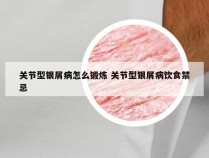 关节型银屑病怎么锻炼 关节型银屑病饮食禁忌