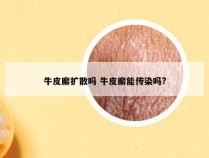 牛皮廨扩散吗 牛皮廨能传染吗?