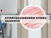 克罗恩病引起全身脓疱型银屑病 克罗恩病会引起皮肤溃烂吗