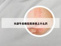 头部牛皮癣出现渗液上什么药