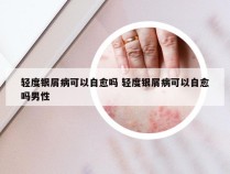 轻度银屑病可以自愈吗 轻度银屑病可以自愈吗男性