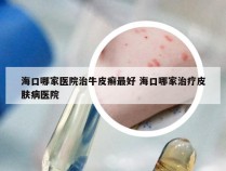 海口哪家医院治牛皮癣最好 海口哪家治疗皮肤病医院