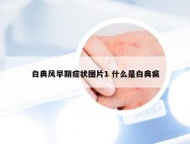 白典风早期症状图片1 什么是白典疯