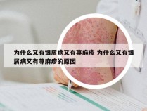 为什么又有银屑病又有荨麻疹 为什么又有银屑病又有荨麻疹的原因