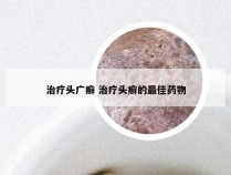 治疗头广癣 治疗头癣的最佳药物