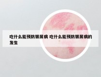 吃什么能预防银屑病 吃什么能预防银屑病的发生