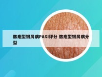 脓疱型银屑病PASI评分 脓疱型银屑病分型