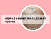 银屑病与雷公藤多甘片 银屑病吃雷公藤多苷片多久有效