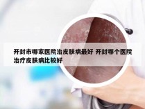 开封市哪家医院治皮肤病最好 开封哪个医院治疗皮肤病比较好