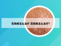 花斑癣怎么治疗 花斑癣怎么治疗?