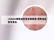 redwin煤焦油洗发水银屑病 煤焦油去屑洗发水