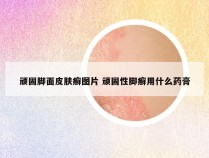 顽固脚面皮肤癣图片 顽固性脚癣用什么药膏