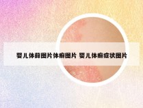 婴儿体藓图片体癣图片 婴儿体癣症状图片