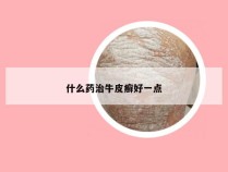 什么药治牛皮癣好一点