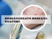 银屑病私处可以照光治疗吗 银屑病私处可以照光治疗吗图片