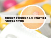 郏县秦现杰皮肤科效果怎么样 河南省平顶山市郏县秦现杰皮肤科