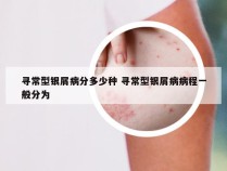 寻常型银屑病分多少种 寻常型银屑病病程一般分为