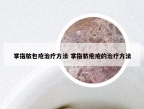 掌指脓包疮治疗方法 掌指脓疱疮的治疗方法