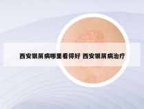 西安银屑病哪里看得好 西安银屑病治疗