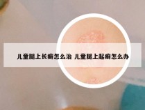 儿童腿上长癣怎么治 儿童腿上起癣怎么办