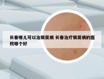 长春哪儿可以治银屑病 长春治疗银屑病的医院哪个好