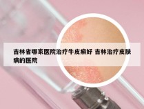 吉林省哪家医院治疗牛皮癣好 吉林治疗皮肤病的医院