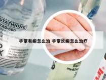 手掌有癣怎么治 手掌长癣怎么治疗