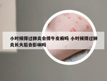 小时候得过肺炎会得牛皮癣吗 小时候得过肺炎长大后会影响吗