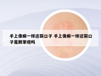 手上像癣一样还裂口子 手上像癣一样还裂口子是鹅掌疮吗