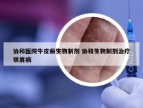 协和医院牛皮癣生物制剂 协和生物制剂治疗银屑病