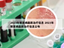 2023年银屑病最新治疗信息 2023年银屑病最新治疗信息公布