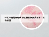 什么样的是银屑病 什么样的银屑病需要打生物制剂