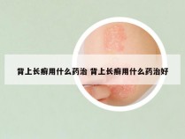 背上长癣用什么药治 背上长癣用什么药治好