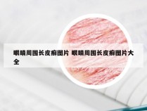 眼睛周围长皮癣图片 眼睛周围长皮癣图片大全