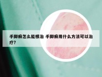 手脚癣怎么能根治 手脚癣用什么方法可以治疗?