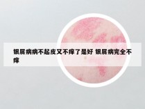 银屑病病不起皮又不痒了是好 银屑病完全不痒