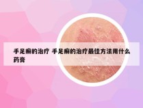 手足癣的治疗 手足癣的治疗最佳方法用什么药膏