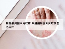 银屑病周围大片红疹 银屑病周围大片红疹怎么治疗