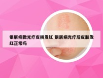 银屑病做光疗皮损发红 银屑病光疗后皮肤发红正常吗