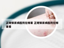 正规银屑病医院在哪里 正规银屑病医院在哪里看