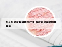 什么叫银屑病的物理疗法 治疗银屑病的物理方法