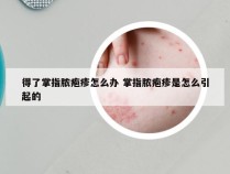 得了掌指脓疱疹怎么办 掌指脓疱疹是怎么引起的